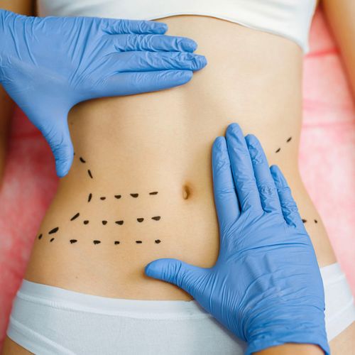 Liposuction