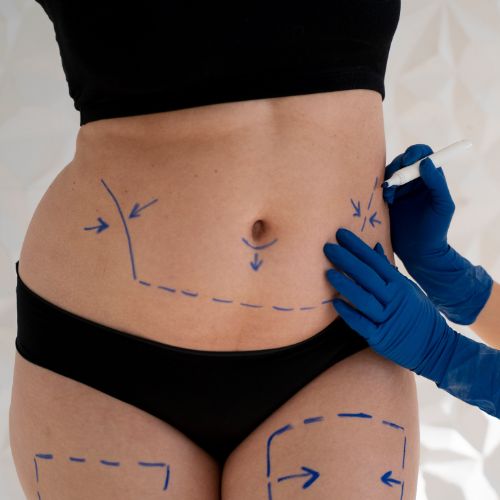tummy tuck